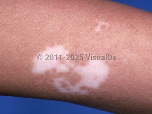 Clinical image of Vitiligo - imageId=779676. Click to open in gallery.  caption: 'A white macule and a similar patch on the forearm.'