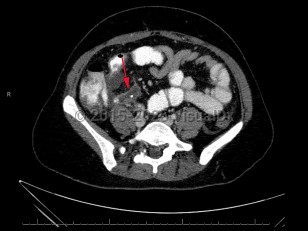 Acute appendicitis