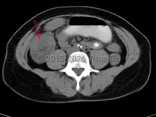 Intussusception
