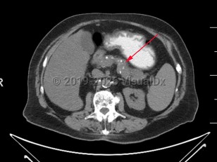Imaging Studies image of Chronic pancreatitis - imageId=7877567. Click to open in gallery.  caption: '<span>Axial CT image demonstrates numerous coarse calcifications within the pancreas, consistent with chronic pancreatitis.</span>'