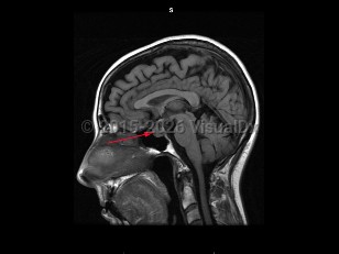 Craniopharyngioma