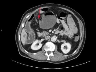 Small bowel obstruction
