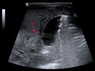 Hypertrophic pyloric stenosis