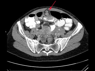 Meckel diverticulum