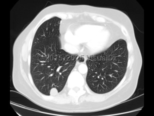 Imaging Studies image of Dirofilariasis - imageId=7879772. Click to open in gallery.  caption: '<span>CT image of pulmonary nodule</span>.'