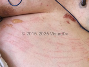 Clinical image of Acute edema blister - imageId=7880509. Click to open in gallery.  caption: 'Patterned vesicles, bullae, crusts, and surrounding erythema on an edematous abdomen.'