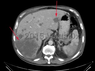 Imaging Studies image of Liver cancer - imageId=7884783. Click to open in gallery.  caption: '<span>Large low attenuation lesion in  the right lobe of the liver as well as several other smaller low  attenuation lesions consistent with metastatic disease to the liver.</span>'