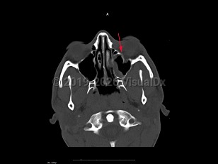 Imaging Studies image of Blow-out fracture of orbit - imageId=7888574. Click to open in gallery.  caption: '<span>Axial CT sequence demonstrates  a depressed fracture of the inferior wall of the orbit. On soft tissue  windows there is a small left maxillary hemosinus.</span>'
