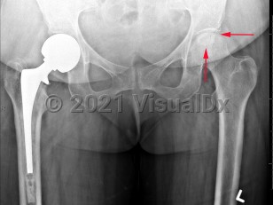 Imaging Studies image of Avascular necrosis of hip - imageId=7893859. Click to open in gallery.  caption: '<span>Serpiginous geographic  sclerosis with lucent center involving the subchondral portion of the  left femoral head compatible with AVN.</span>'