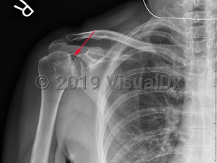 Imaging Studies image of Avascular necrosis of shoulder - imageId=7895431. Click to open in gallery.  caption: '<span>AVN/osteonecrosis of the right humeral head with subchondral collapse and sclerosis.</span>'