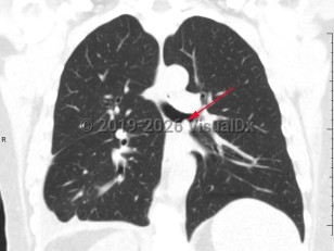 Bronchial carcinoid tumor