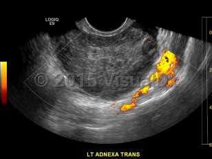 Imaging Studies image of Ovarian torsion - imageId=7904892. Click to open in gallery.  caption: '<span>Ultrasound image demonstrates  enlarged, heterogeneous left ovary with peripheralized follicles and  absence of flow. Findings consistent with clinical diagnosis of ovarian  torsion.</span>'