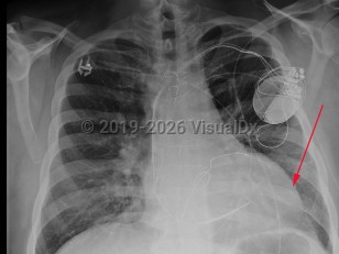 Dilated cardiomyopathy