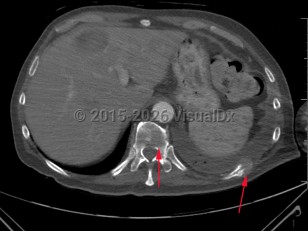 Imaging Studies image of Pathologic fracture - imageId=7909114. Click to open in gallery.  caption: '<span>Lytic lesions involving the thoracic spine, and a left-sided rib with pathologic fracture. These lesions were found to represent metastatic lung cancer.</span>'