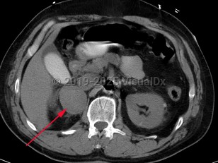 Imaging Studies image of Pheochromocytoma - imageId=7911948. Click to open in gallery.  caption: 'Patient presented with labile blood pressure. Unenhanced CT scan of the abdomen demonstrates a large complex right adrenal mass, surgically proven pheochromocytoma.'