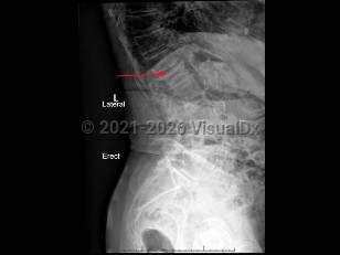 Imaging Studies image of Osteoporotic vertebral compression fracture - imageId=7914694. Click to open in gallery.  caption: '<span>Compression fracture of the L1  vertebral body involving both the superior and inferior endplates in a  patient with diffuse osteopenia, compatible with an osteoporotic  compression fracture.</span>'