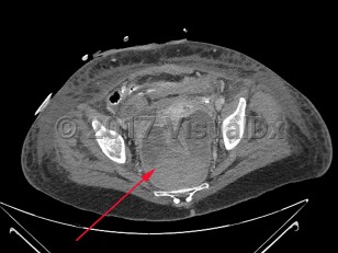 Imaging Studies image of Perirectal abscess - imageId=7915658. Click to open in gallery.  caption: '<span>Axial CT image of a  large perirectal abscess with hemorrhage in a patient recently  postoperative with rectal perforation.</span>'