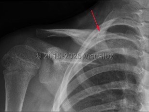 Imaging Studies image of Chronic recurrent multifocal osteomyelitis - imageId=7918092. Click to open in gallery.  caption: '<span>Hyperostosis and chronic  lamellated periosteal reaction involving the medial end of the clavicle.  These findings can be seen with CRMO.</span>'