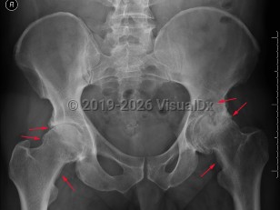 Osteoarthritis