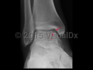 Imaging Studies image of Osteochondral defect - imageId=7921453. Click to open in gallery.  caption: '<span>Lucency at the medial talar dome compatible with an osteochondral defect.</span>'