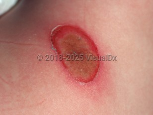Clinical image of Bullous impetigo - imageId=813507. Click to open in gallery.  caption: 'A close-up of a crusted erosion with a collarette of scale.'