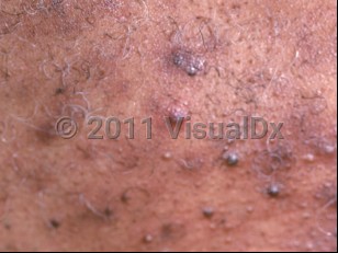 Clinical image of Steroid acne - imageId=816855. Click to open in gallery.  caption: 'A close-up of follicular-based, closed comedones and papules, resulting from topical steroid use.'