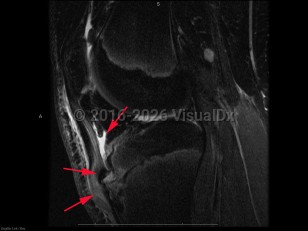 Osgood-Schlatter disease