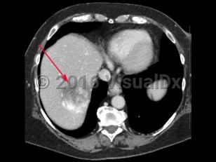 Imaging Studies image of Hepatic hemangioma - imageId=8340259. Click to open in gallery.  caption: '<span>Contrast enhanced axial CT scan of the abdomen demonstrates a mass in the right lobe of the liver with peripheral enhancement, consistent with hepatic hemangioma.</span>'