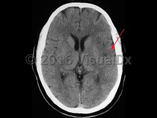 Imaging Studies image of Cerebral stroke - imageId=8342528. Click to open in gallery.  caption: '<span>CAT scan demonstrating left-sided MCA territory stroke, seen as hypodense region in left temporal lobe.</span>'