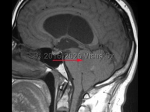 Imaging Studies image of Ependymoma - imageId=8342748. Click to open in gallery.  caption: '<span>T1 weighted sagittal MRI demonstrating ependymoma of the fourth ventricle.</span>'