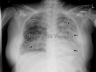 Acute respiratory distress syndrome