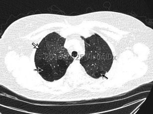 Imaging Studies image of Bronchiolitis obliterans - imageId=8347118. Click to open in gallery.  caption: '<span>Axial 0.90mm slice thickness  non-contrast CT image of the chest viewed in lung windows in the upper  chest. Axial CT image of the chest demonstrates mosaic attenuation  throughout both lungs, with geographic areas of decreased attenuation  (straight black arrows) and decreased vascularity (straight white  arrow).</span>'
