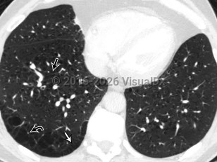 Pulmonary emphysema