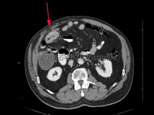 Colon cancer