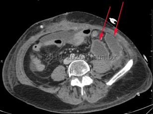 Intraabdominal abscess