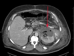 Perinephric abscess