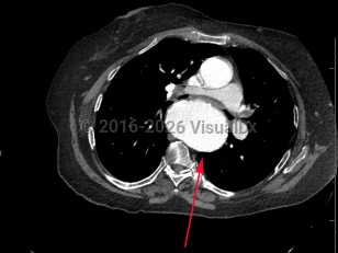 Imaging Studies image of Thoracic aortic aneurysm - imageId=8361372. Click to open in gallery.  caption: '<span>Axial image from enhanced CT scan of the chest showing a large aneurysm of the descending thoracic aorta.</span>'