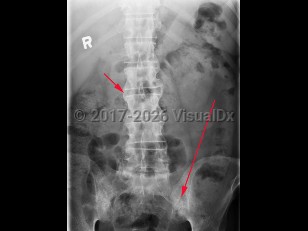 Ankylosing spondylitis