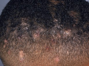 Tinea capitis