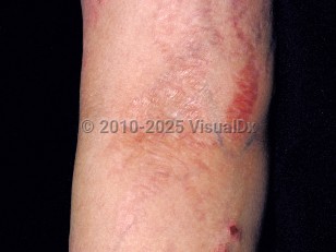 Clinical image of Steroid atrophy - imageId=87413. Click to open in gallery.  caption: 'A shiny, atrophic plaque in the antecubital fossa and surrounding white and brightly erythematous, curvilinear plaques (striae).'