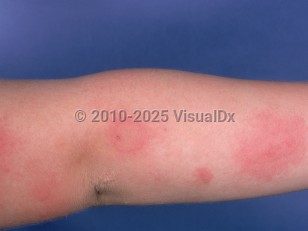 Clinical image of Solar urticaria - imageId=879551. Click to open in gallery.  caption: 'Urticarial plaques on the extensor forearm.'