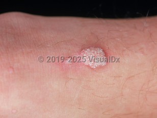 Clinical image of Common wart - imageId=885707. Click to open in gallery.  caption: 'A close-up of a verrucous plaque with overlying white scale and a similar smaller papule.'