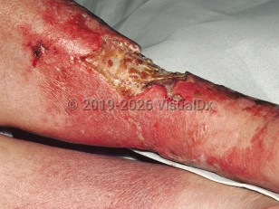 Clinical image of Progressive bacterial synergistic gangrene - imageId=89164. Click to open in gallery.  caption: 'Full thickness loss extending into the deep subcutaneous tissue.'