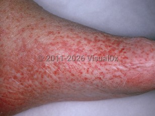 Leukocytoclastic vasculitis