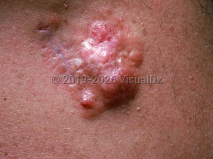 Clinical image of Dermatofibrosarcoma protuberans - imageId=905284. Click to open in gallery.  caption: 'A close-up of a bosselated, white, pink, and brown plaque and an adjacent surgical scar.'