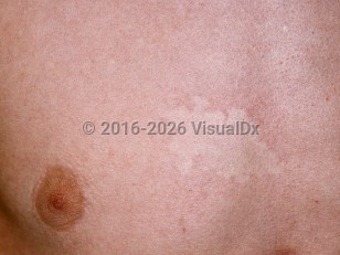 Clinical image of Nevus anemicus - imageId=93049. Click to open in gallery.  caption: 'A white patch with scalloped borders and faint surrounding erythema on the chest.'