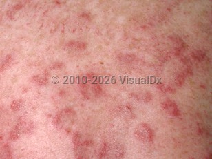Clinical image of Jessner benign lymphocytic infiltrate - imageId=97167. Click to open in gallery.  caption: 'A close-up of numerous deeply erythematous papules and small arcuate plaques.'