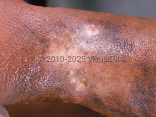 Clinical image of Lymphangiosarcoma - imageId=990911. Click to open in gallery.  caption: 'Grayish and violaceous patches developing in a scarred and lymphedematous limb.'